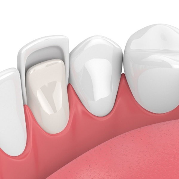 Dental bonding 3d image