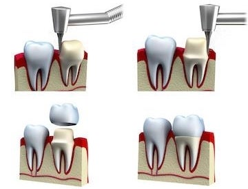 Dental crowns