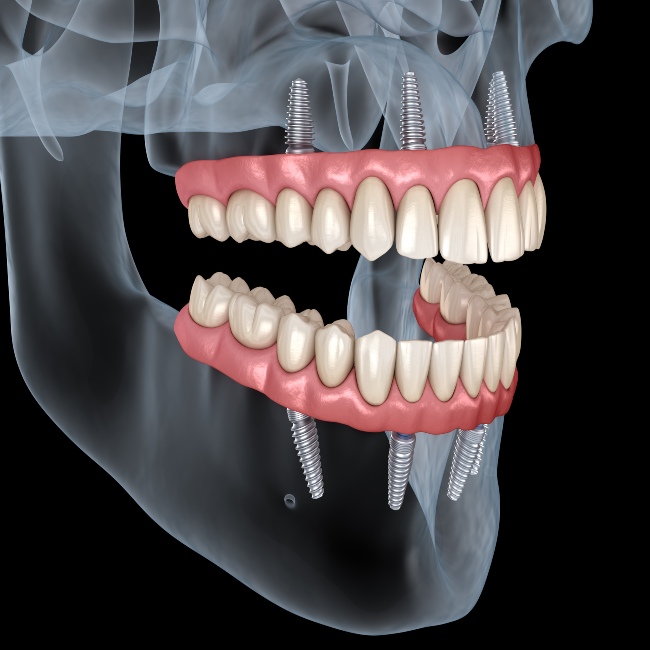 Dental implants 3d image