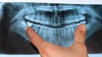 X-ray of a jaw