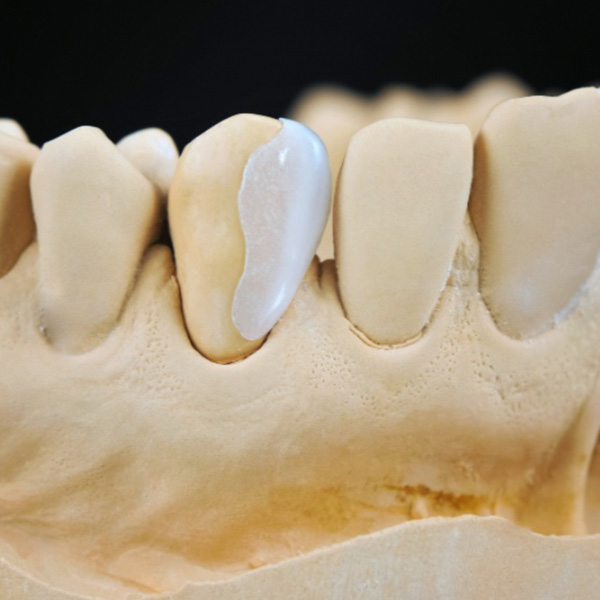 Close up prepless veneers