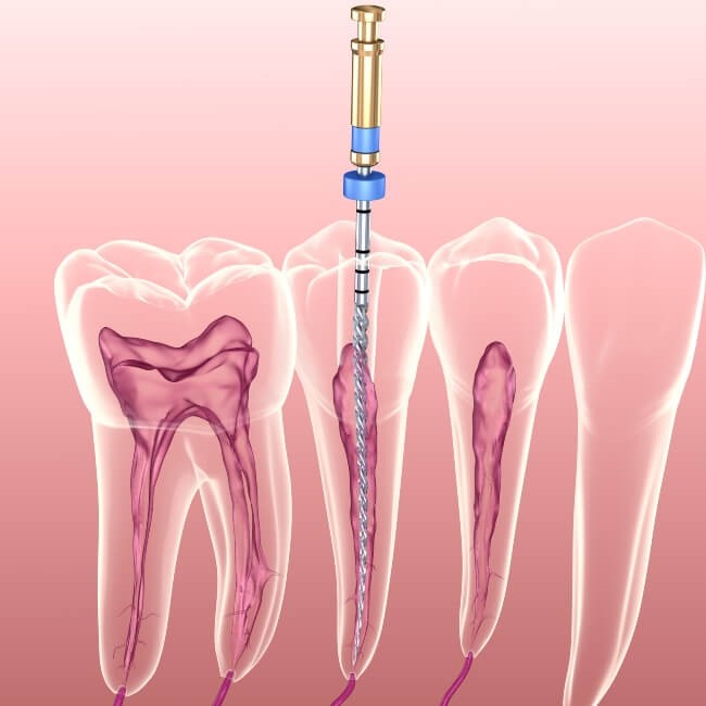 Graphic root canal 3d image