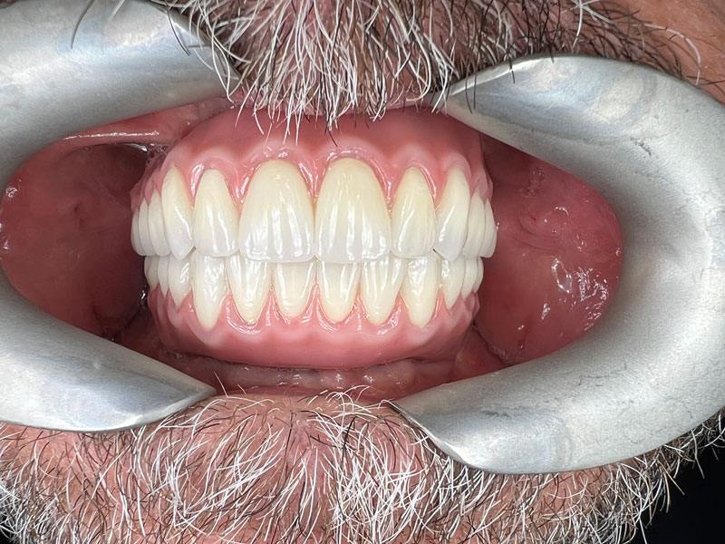 Smile makeover after picture