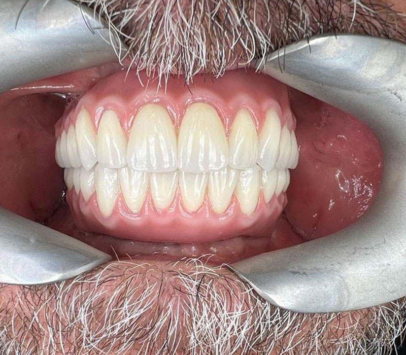 Smile makeover after picture