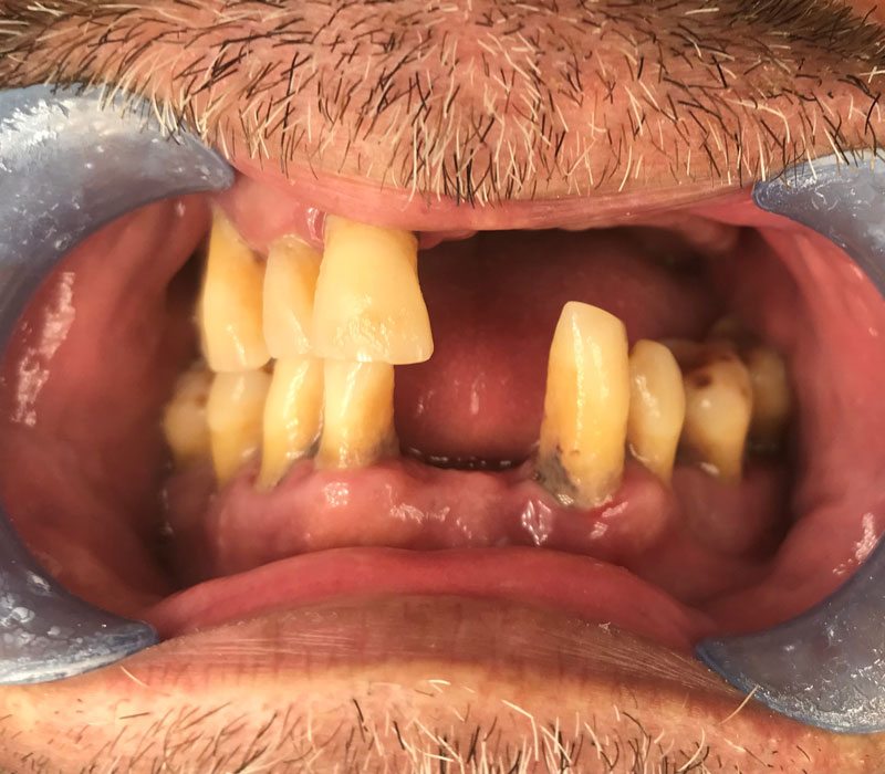 Smile makeover before picture