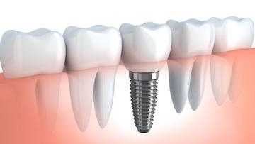 Dental Implants to Replace Missing Teeth 02