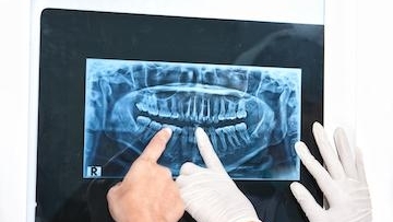 X-Ray of teeth