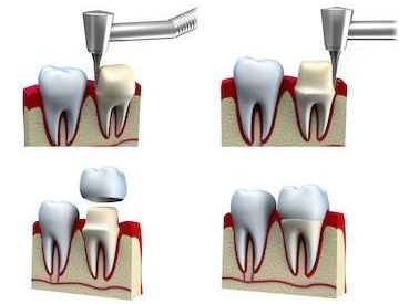 Dental Crowns & Bridges in Phoenix, AZ