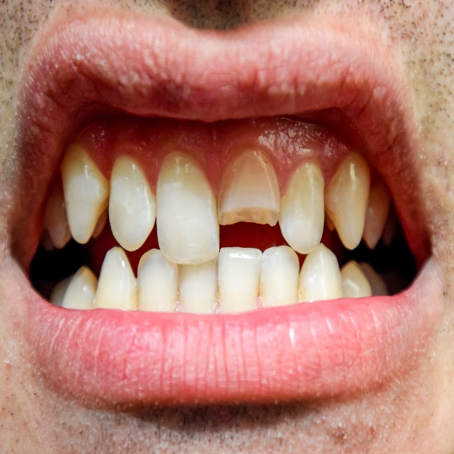 Chipped Tooth Repair in Phoenix, AZ