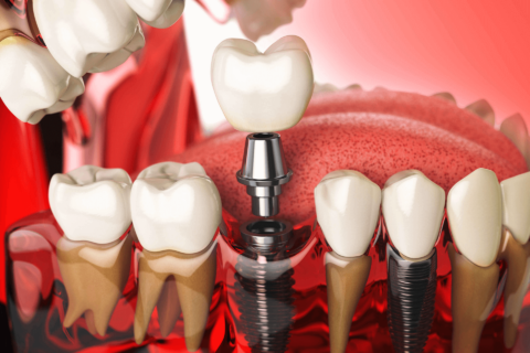 Bone-Grafting-in-Dental-Implant(for-Desert-Ridge)