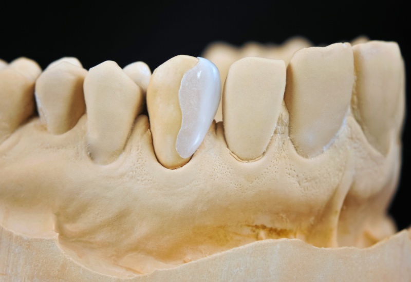 Prepless Veneers in Northern Phoenix, AZ