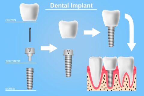 Structure of types of dental implant in Northern Phoenix, AZ