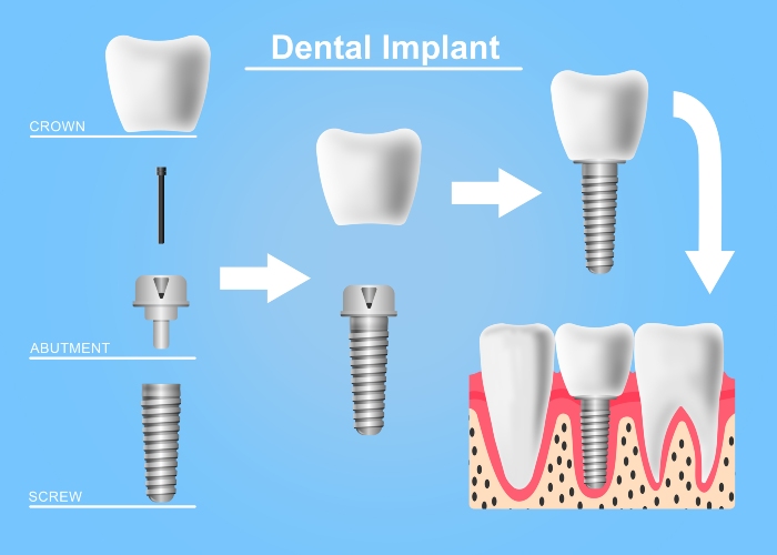 Structure of types of dental implant in North Phoenix, AZ