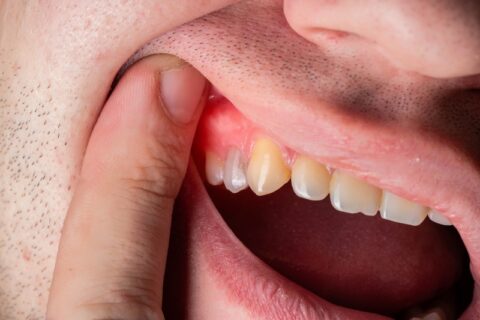 Swollen infected tooth ready for extraction by professional in Northern Phoenix, AZ