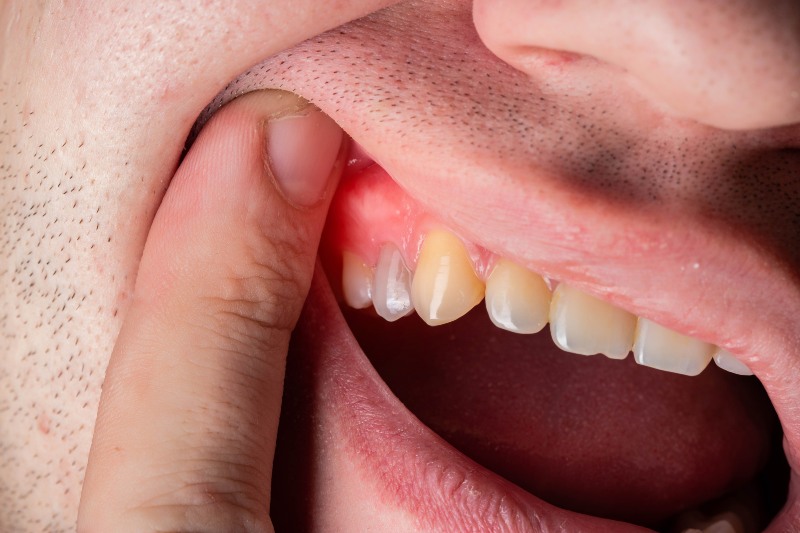Swollen infected tooth ready for extraction by professional in North Phoenix, AZ