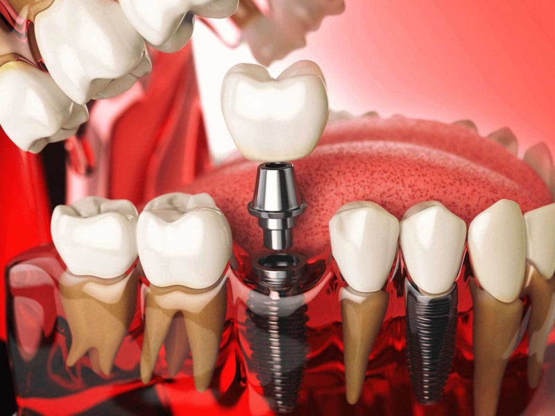 Graphical representation of bone graft procedure in North Phoenix, AZ