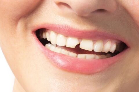 A woman with front cracked teeth needs treatment in North Phoenix, AZ.