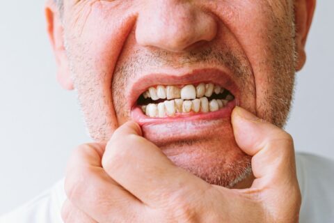 A man showing tooth enamel erosion caused by grinding teeth in North Phoenix, AZ